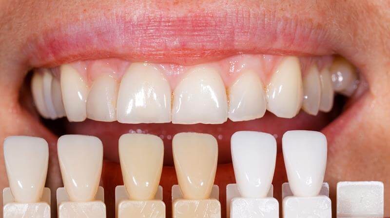 Veneers