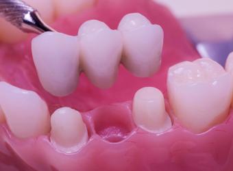 Bridging the Gap: Understanding Dental Bridges in Restorative Dentistry