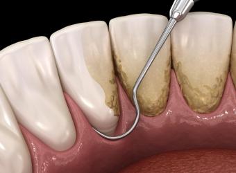 The Stages of Periodontitis: Understanding the Progression