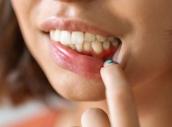 Causes of Gingivitis: Uncovering the Culprits Behind Gum Inflammation